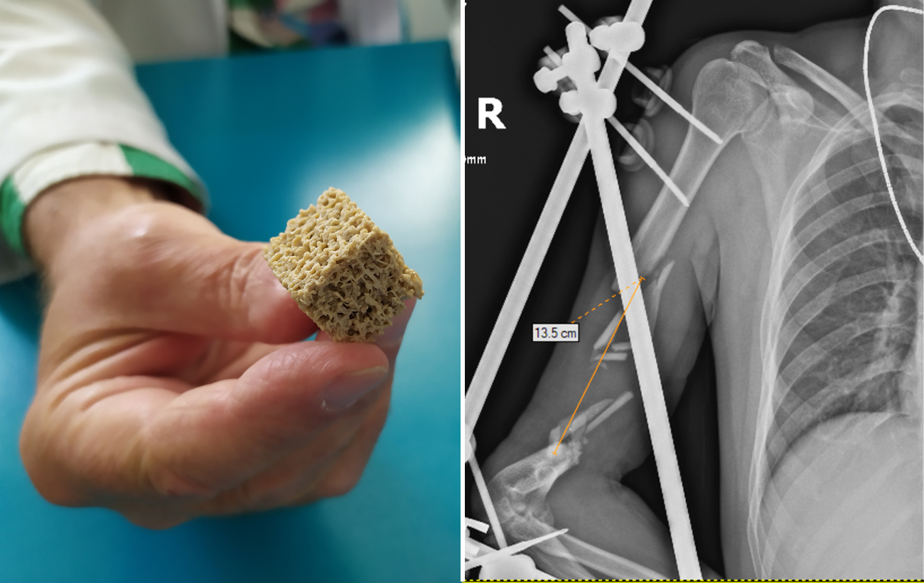 "Ходитимуть своєю ногою, а не протезом". Як в Україні відновлюють кістки військовим